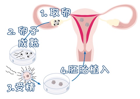 着床前診断 PGT